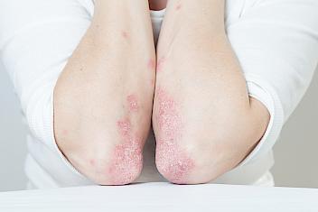 Close-up photo of an eczema flare-up on elbows