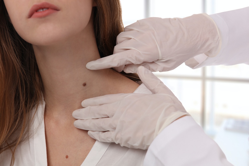 Closeup of woman's neck with clinician observing mole for removal